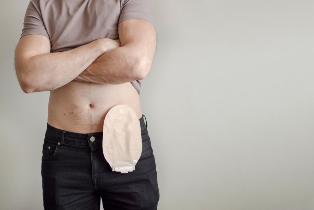 Ostomy Pouch Solutions: A Comprehensive Guide
