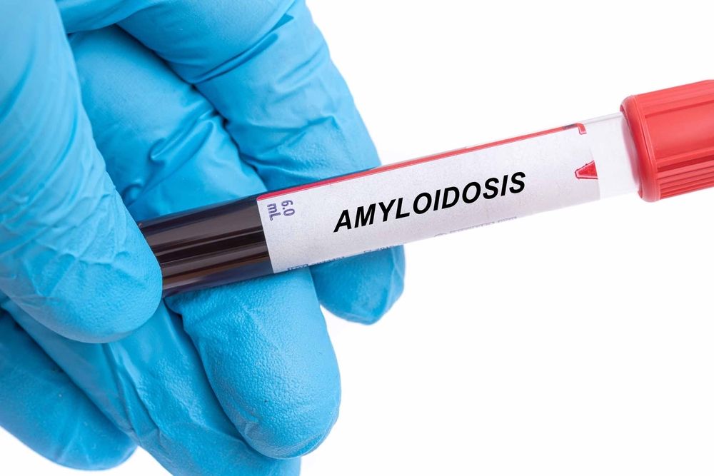 Recognizing Amyloidosis Warning Signs Before They Become Serious