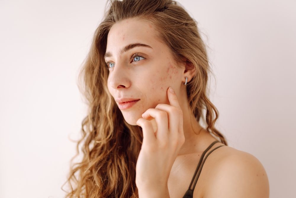 Acne Treatments That Support Clear, Healthy Skin