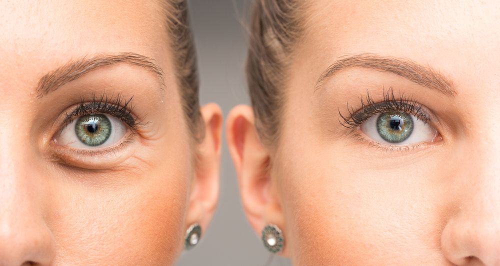 Navigating Laser Surgery for Under Eye Bags